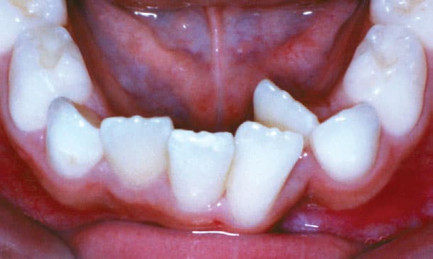 Crowding Orthodontic Studio of Brooklyn NY