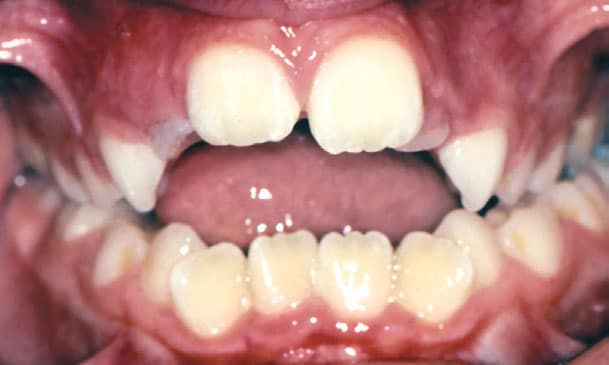 Open Bite Orthodontic Studio of Brooklyn NY