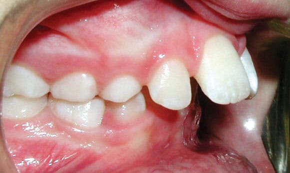 Protrusion Orthodontic Studio of Brooklyn NY
