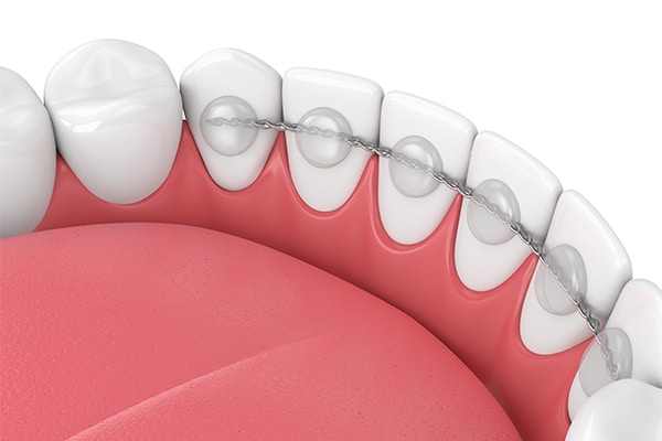 Fixed Retainers Orthodontic Studio of Brooklyn NY